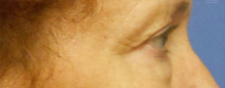 before Blepharoplasty / Eyelid Surgery zoomed side view Case 1666