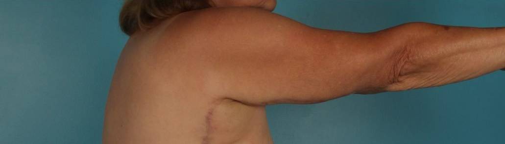 after Brachioplasty / Arm Lift right arm view Case 1680
