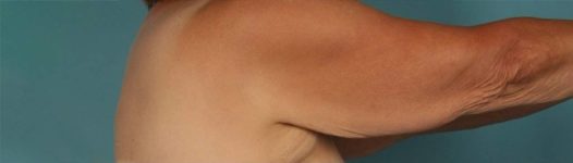 before Brachioplasty / Arm Lift right arm view Case 1680