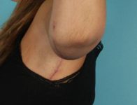 after Brachioplasty / Arm Lift side view Case 1721