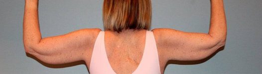 Patient Brachioplasty | Arm Lift Thumbnail Before 1