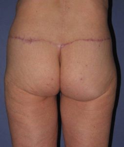 after butt lift back view female patient case 1209