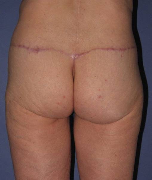 after butt lift back view female patient case 1209