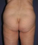 before butt lift back view female patient case 1209