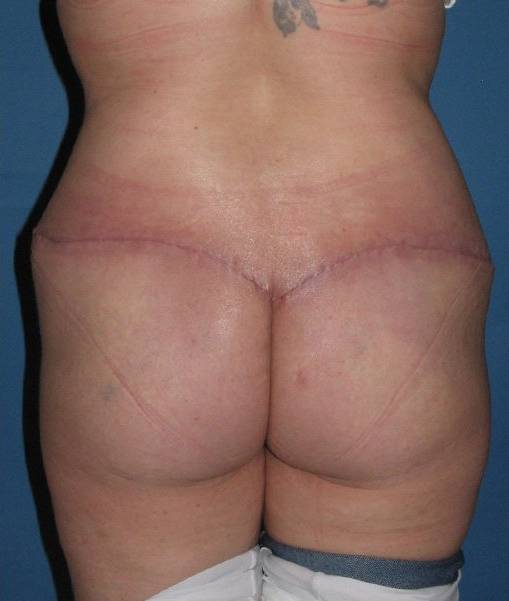 after butt lift back view female patient case 1216