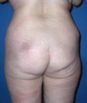 before butt lift back view female patient case 1216