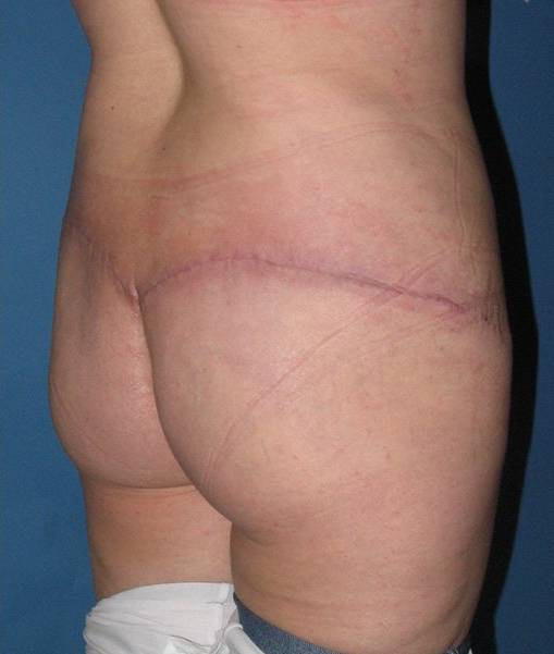 after butt lift angle view female patient case 1216