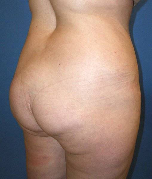 before butt lift angle view female patient case 1216