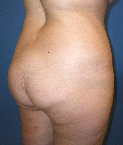 Patient Brazilian Butt Lift Before 1