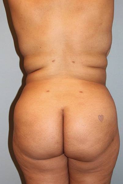 after butt lift back view female patient case 1223