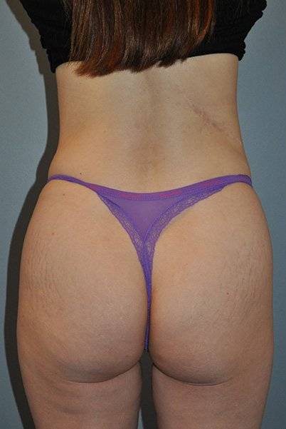 before butt lift back view female patient case 1244