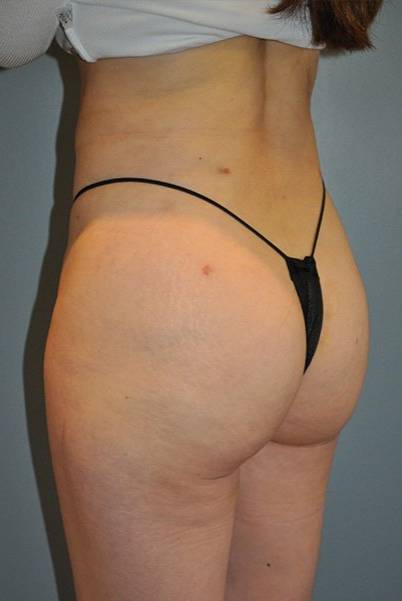 after butt lift angle view female patient case 1244