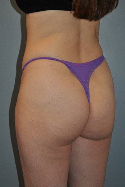 Patient Brazilian Butt Lift Before 1