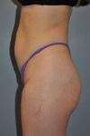 before butt lift side view female patient case 1244