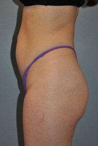 before butt lift side view female patient case 1244