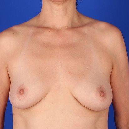 Patient Breast Augmentation Before 0