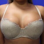 Patient Breast Augmentation Thumbnail Before 3