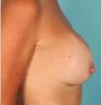 after breast augmentation side view case 1308
