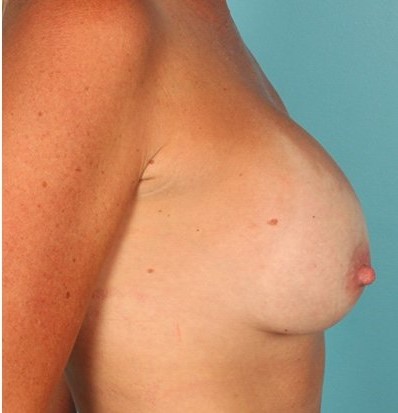 after breast augmentation side view case 1308