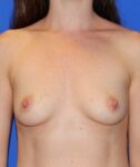 Patient Breast Augmentation Thumbnail Before 0