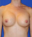 Patient Breast Augmentation Thumbnail After 0