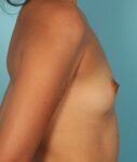 before breast augmentation side view Case 1418