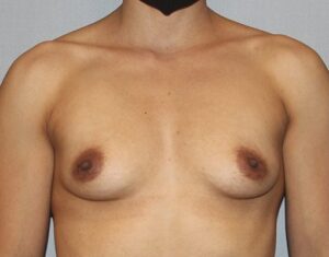 Patient Breast Augmentation Before 0