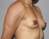 Patient Breast Augmentation Thumbnail Before 1