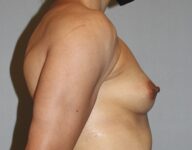 before breast augmentation right side view Case 1446