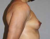 Patient Breast Augmentation Thumbnail Before 2