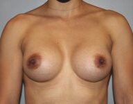 Patient Breast Augmentation Thumbnail After 0