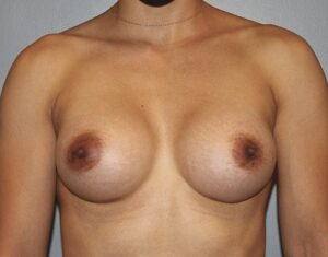 Patient Breast Augmentation After 0