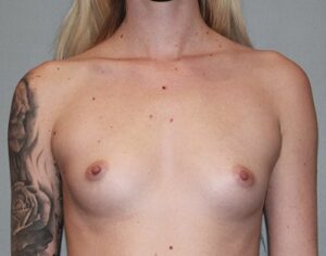 Patient Breast Augmentation Before 0