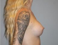 after breast augmentation side view Case 1453