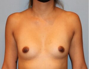 Patient Breast Augmentation Before 0