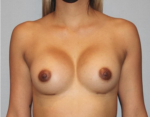 after breast augmentation front view Case 1469