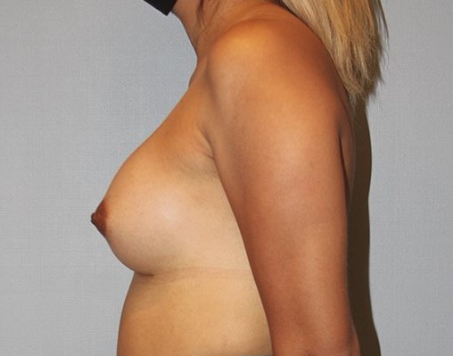 Patient Breast Augmentation Before 2