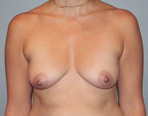 before breast augmentation front view Case 1476