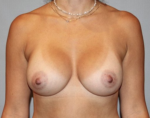 after breast augmentation front view Case 1476