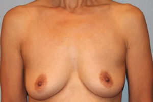 Patient Breast Augmentation Before 0