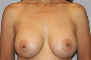Patient Breast Augmentation After 0