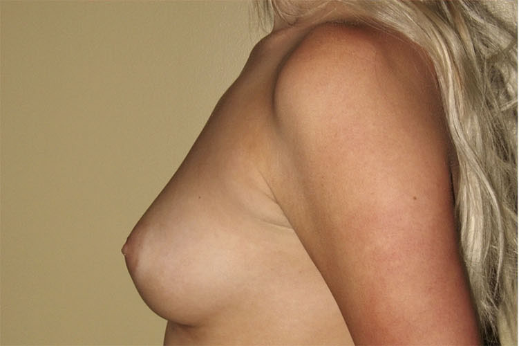 Patient Breast Augmentation Before 2