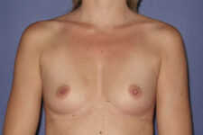 Patient Breast Augmentation Thumbnail Before 0