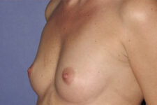 Patient Breast Augmentation Thumbnail Before 1