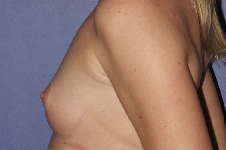 Patient Breast Augmentation Before 2