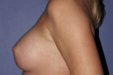 Patient Breast Augmentation Thumbnail After 2