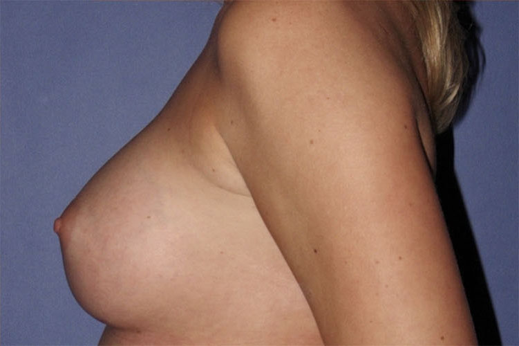 Patient Breast Augmentation Before 2
