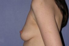 Patient Breast Augmentation Thumbnail Before 2