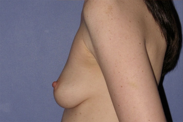 Patient Breast Augmentation Before 2