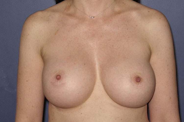 Patient Breast Augmentation Before 0